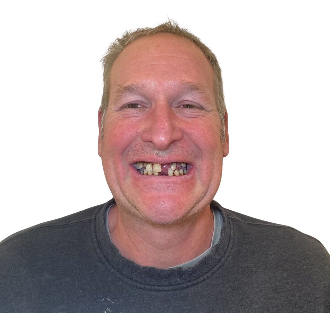 A middle-aged man with short, light hair smiles widely, showing several missing and misaligned teeth. He is wearing a dark grey sweatshirt and is set against a plain white background.