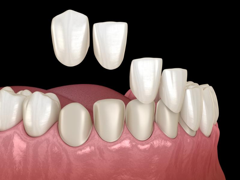 full-mouth porcelain teeth in calgary