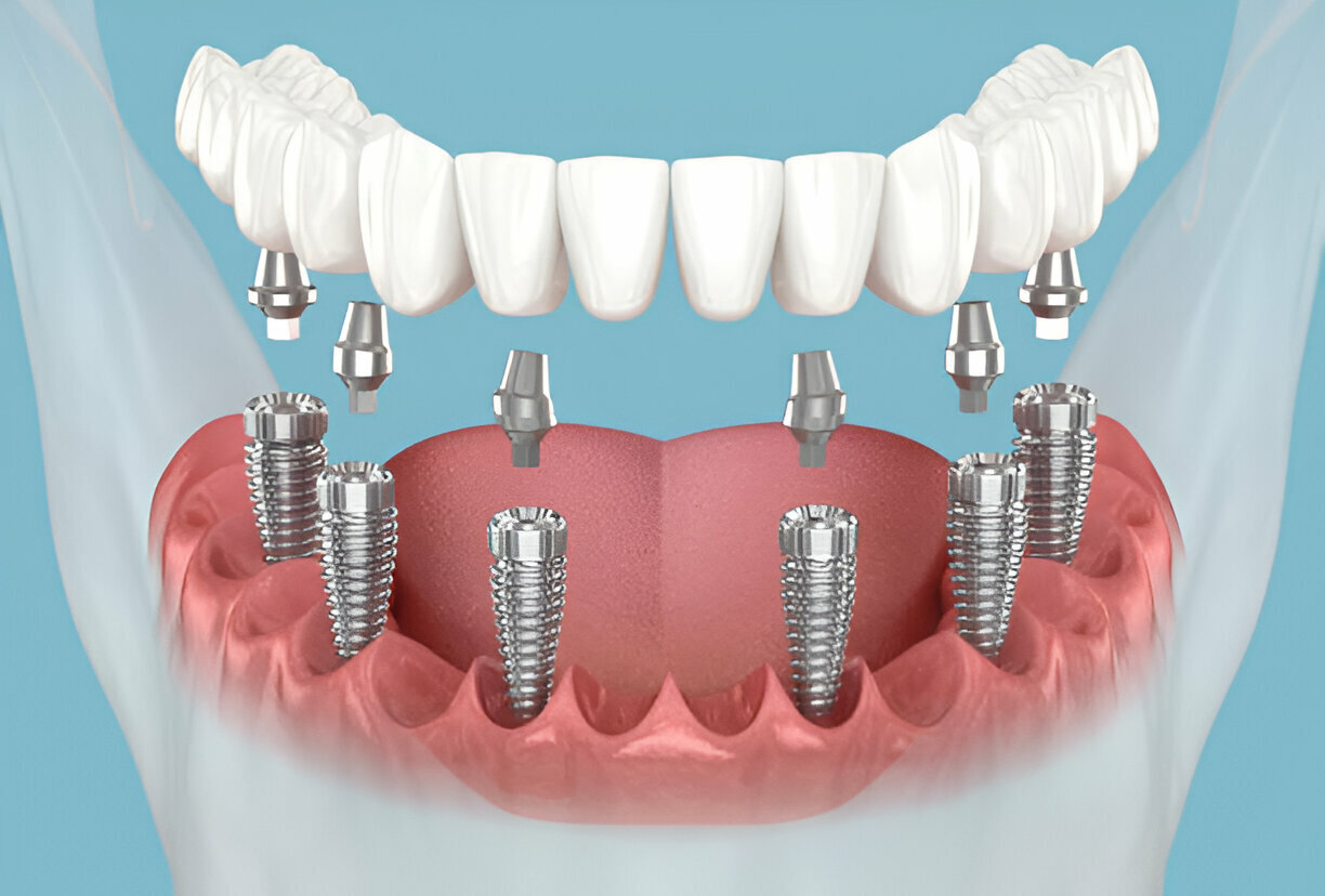 implant supported dentures in edmonton