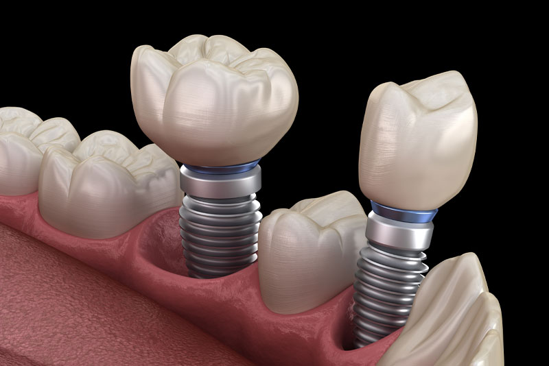 multi-tooth implants in calgary