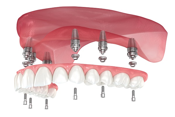 implant supported dentures red deer