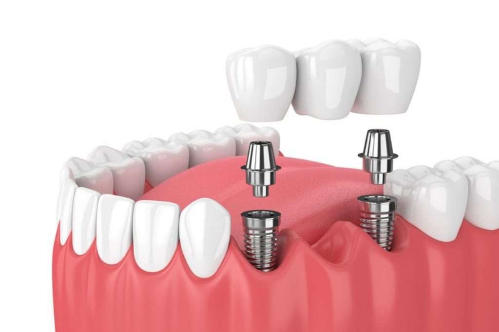 multi tooth implants in red deer
