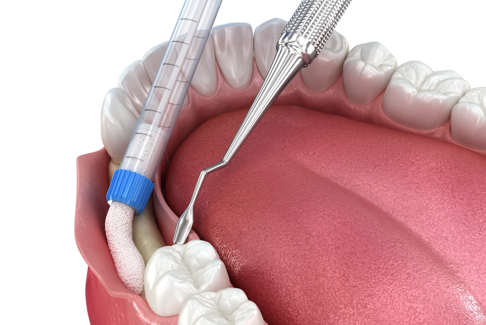 dental bone grafting and why Is it needed