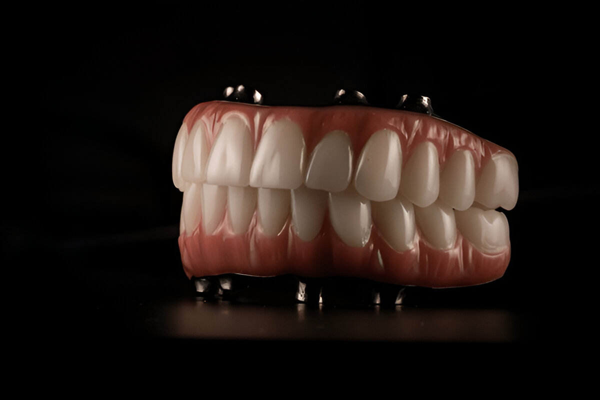 What are Implant-Supported Dentures?