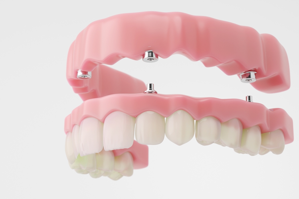 what are implant supported dentures