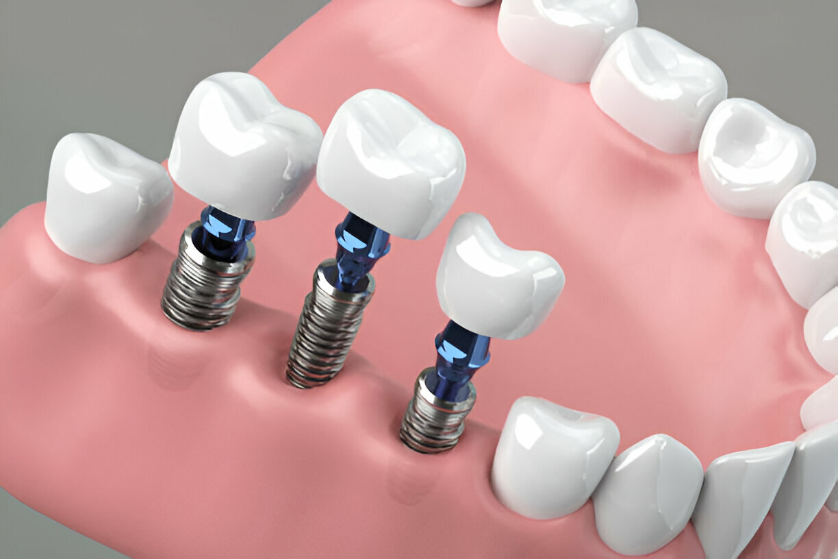 Multi-Tooth Implants Near You