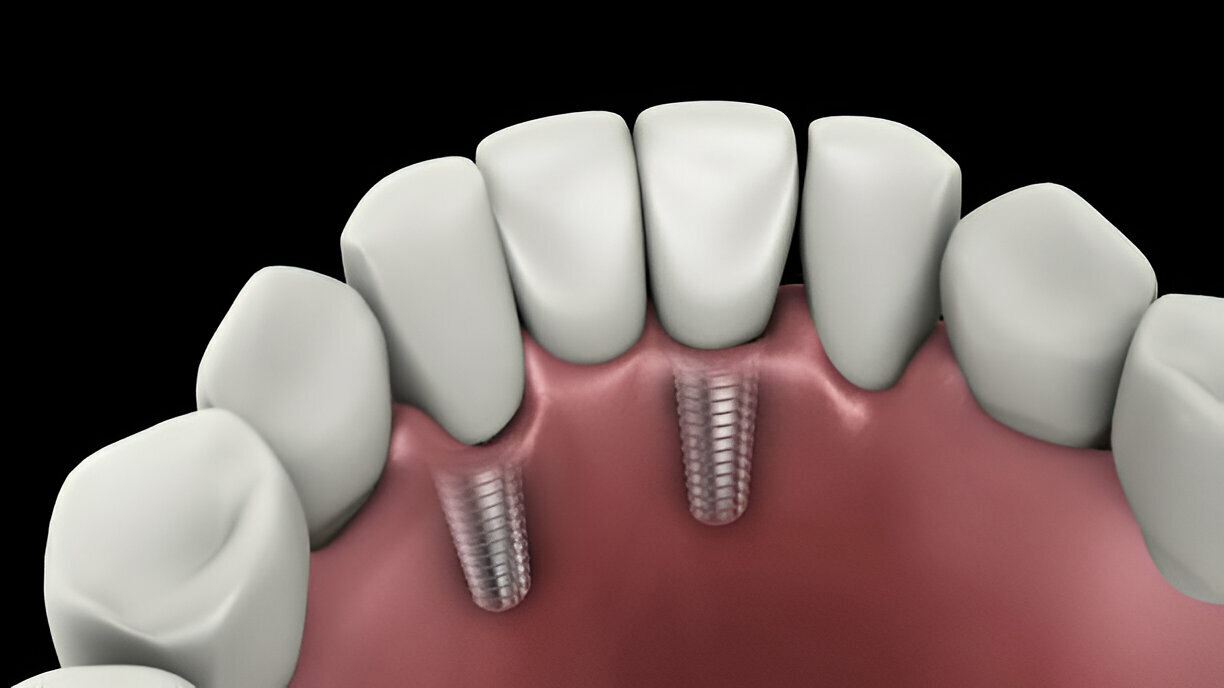 What are Multi-Tooth Implants?