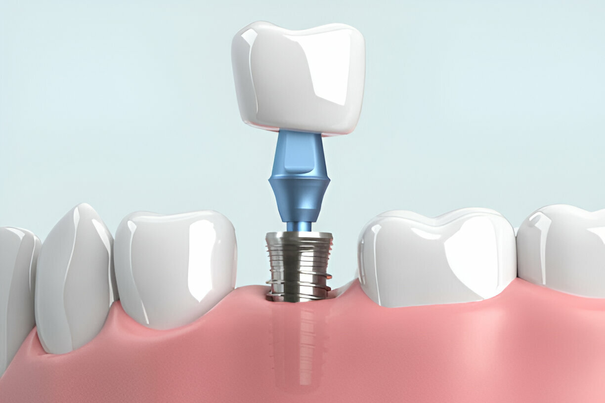 What Are Multi-Tooth Implants?
