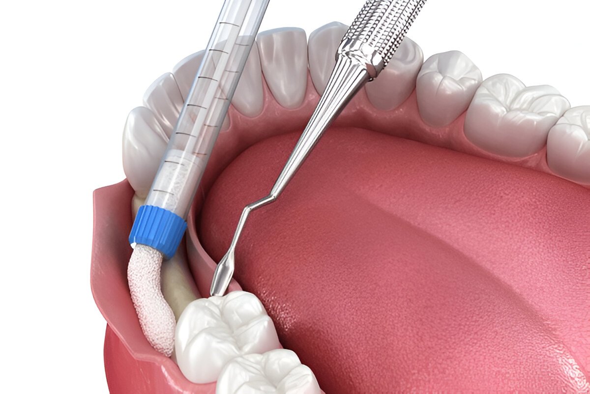 What is Bone Grafting?