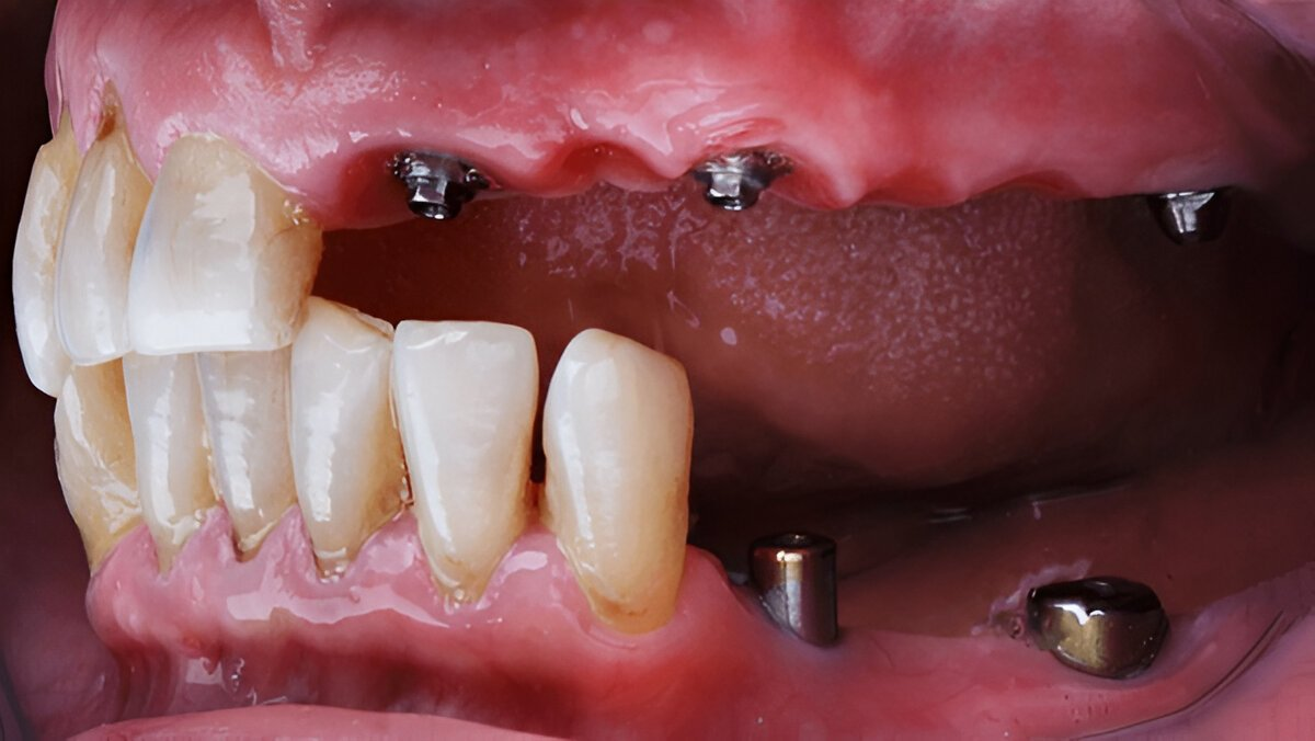 Multi-Tooth Implants Near You