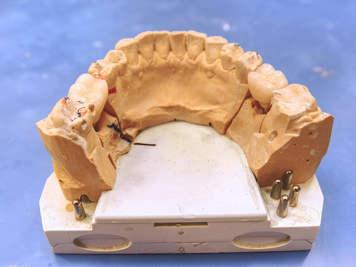 What Are Multi-Tooth Implants?