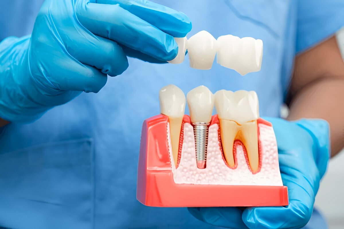 What Are Same-Day Dental Implants?