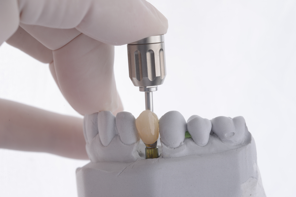 single tooth dental implant