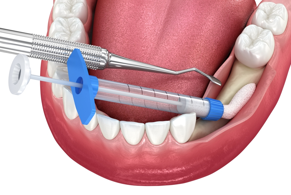 why is bone grafting necessary for dental implants