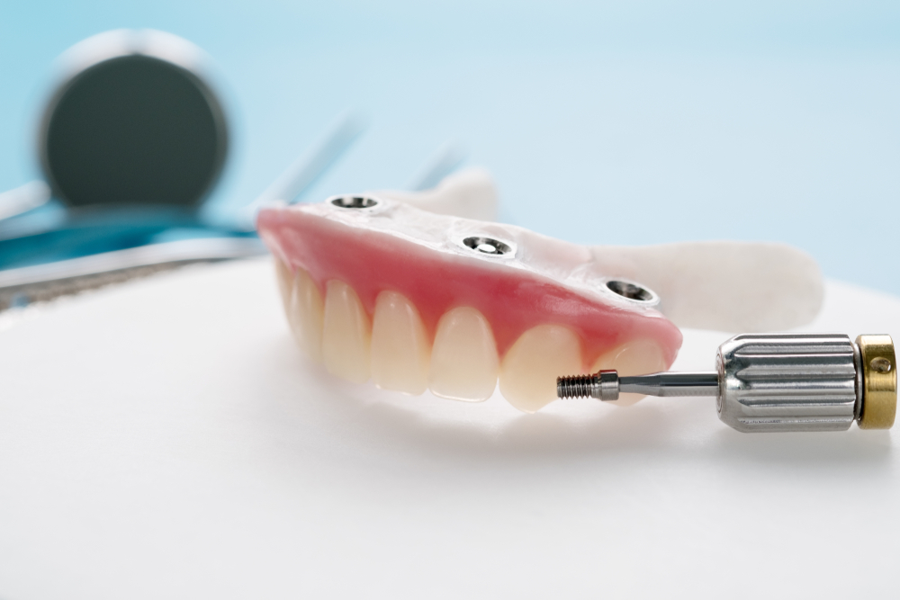 implant supported dentures more stable