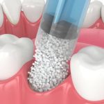 What Types Of Bone Grafts Are Used In Dentistry, And What Is The Cost Of Bone Grafting?