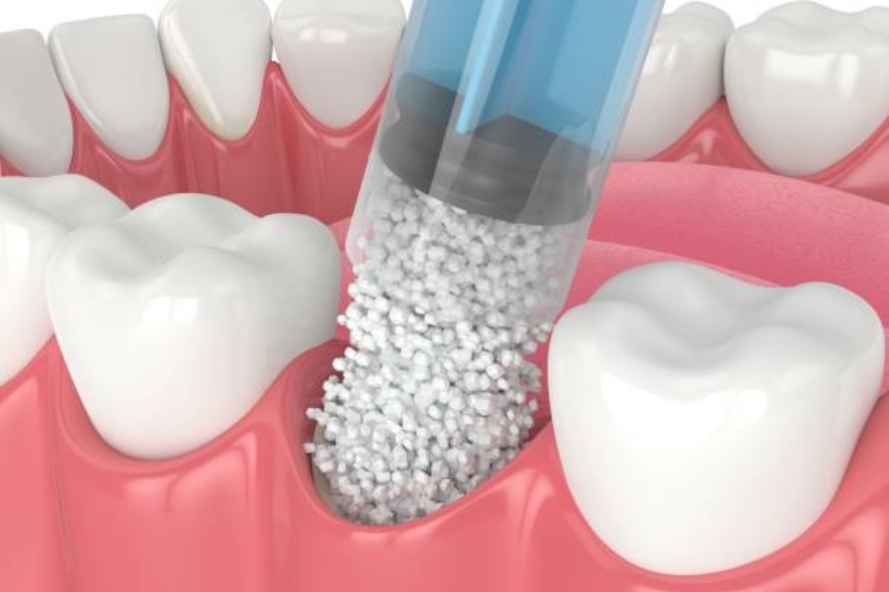 What Types Of Bone Grafts Are Used In Dentistry, And What Is The Cost Of Bone Grafting?