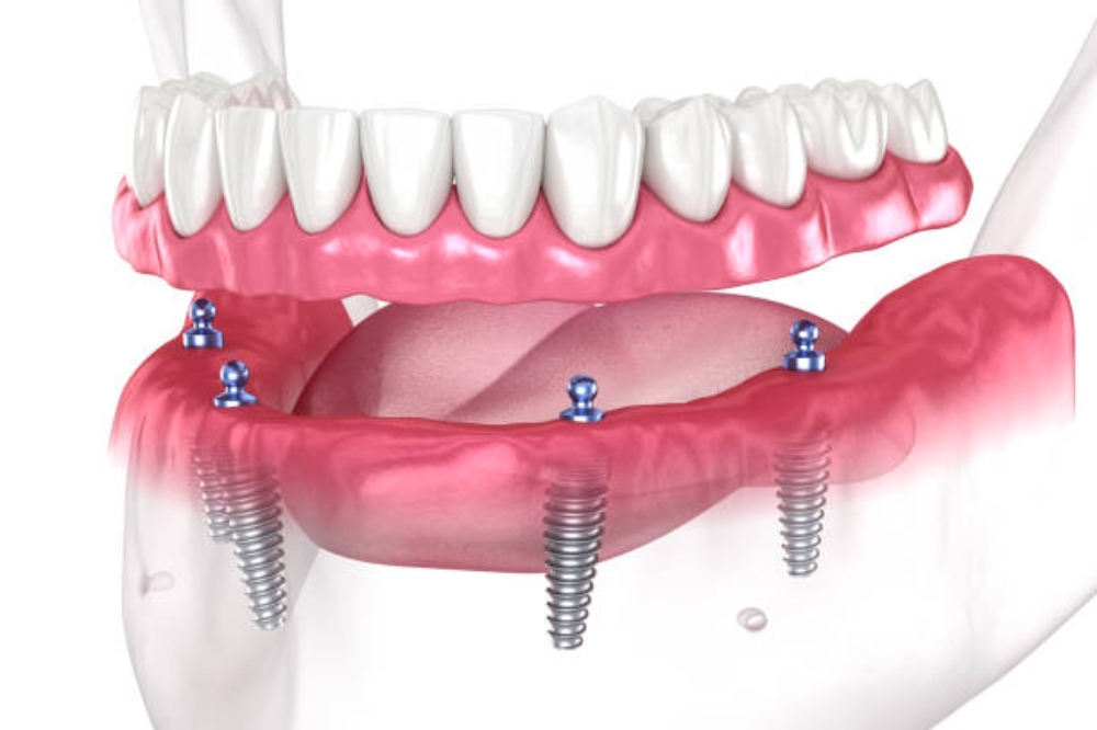 How Are Implant-Supported Dentures Different From Regular Dentures?