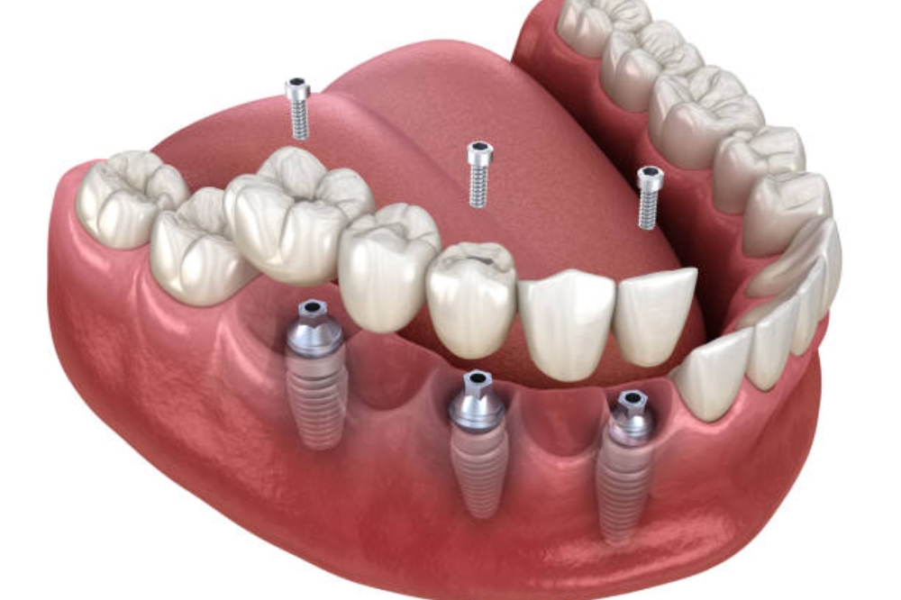 Multi-Tooth Implants vs Dental Bridges – Which Is Better?