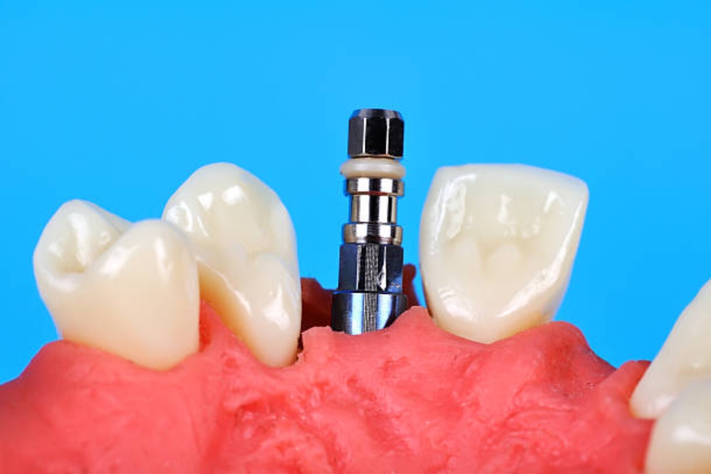 Multi-Tooth Implants vs Dental Bridges – Which Is Better?