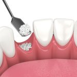 Dental Bone Grafting: What to Expect and How It Can Improve Your Smile