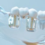 How Multi-Tooth Implants Can Restore Your Smile and Confidence
