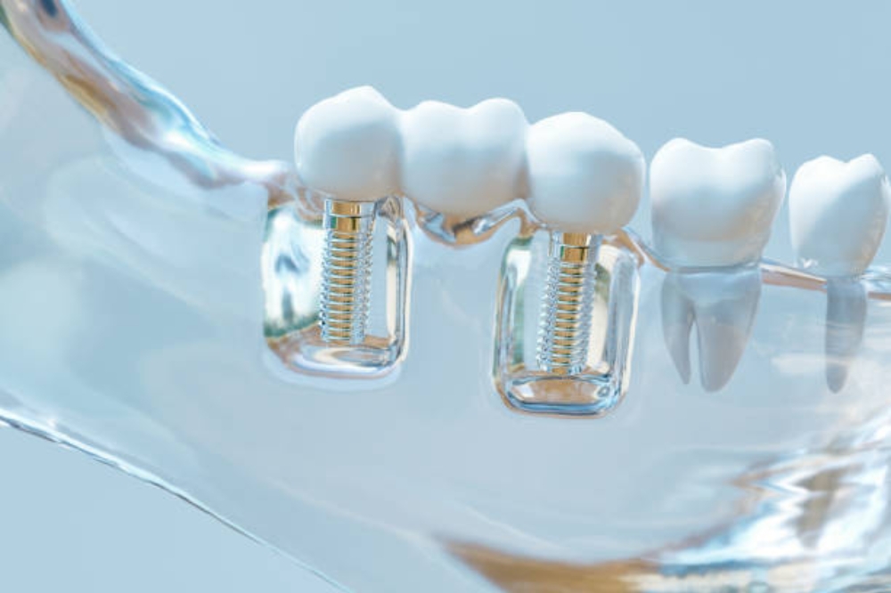 How Multi-Tooth Implants Can Restore Your Smile and Confidence