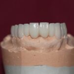 Full-Mouth Porcelain Teeth: A Complete Guide to Restoring Your Smile