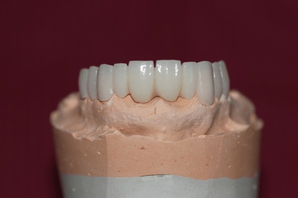 Full-Mouth Porcelain Teeth: A Complete Guide to Restoring Your Smile