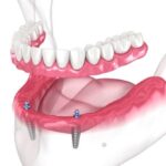 Implant-Supported Dentures: Why They Are A Smart Investment For Your Smile And Health