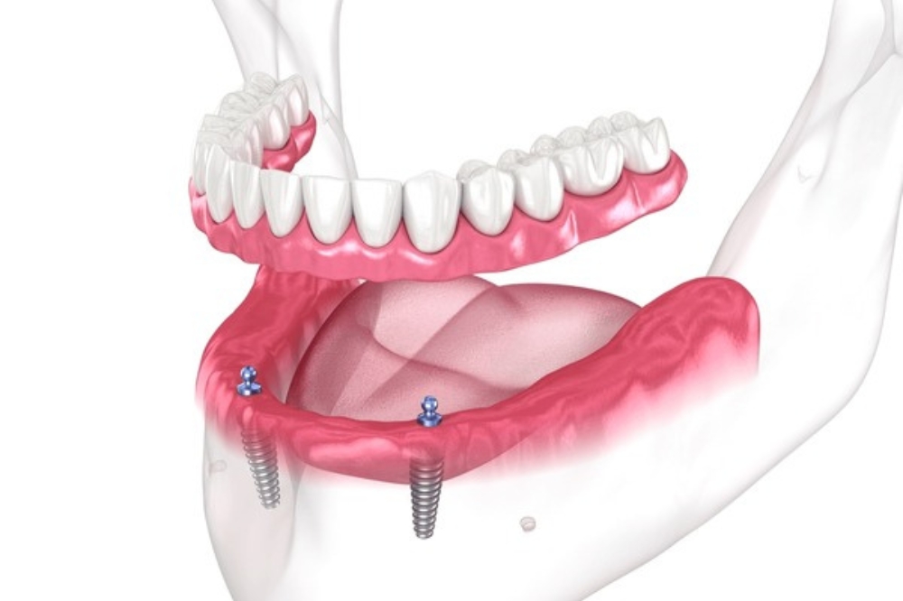 Implant-Supported Dentures: Why They Are A Smart Investment For Your Smile And Health