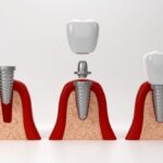 The Step-By-Step Process Of Getting A Single-Tooth Dental Implant