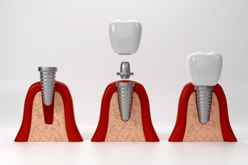 The Step-By-Step Process Of Getting A Single-Tooth Dental Implant