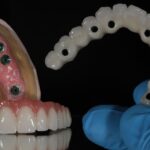 multi tooth implants the best solution for replacing multiple missing teeth