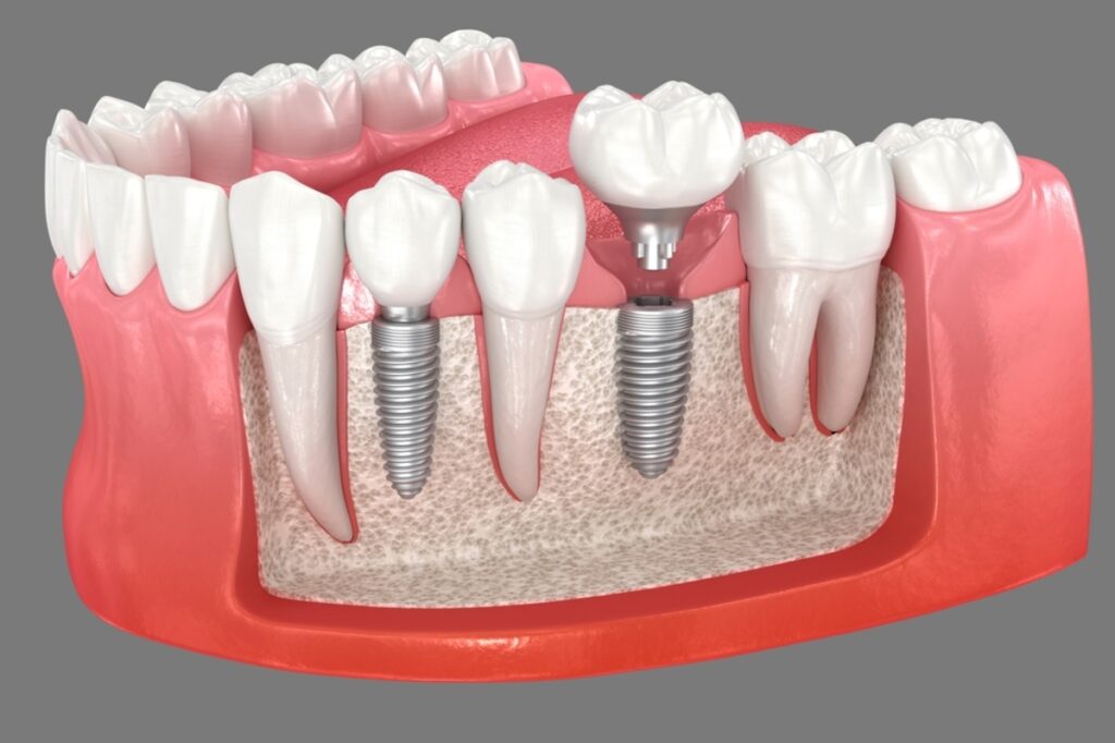 multi tooth implants how to know if you're ready for the procedure