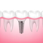 same-day dental implants how is it possible to leave with teeth in one visit
