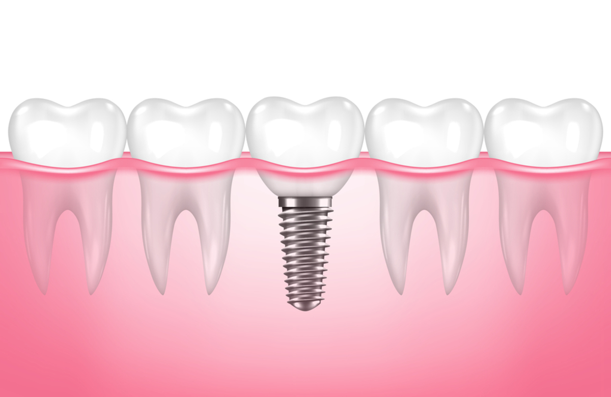 same-day dental implants how is it possible to leave with teeth in one visit