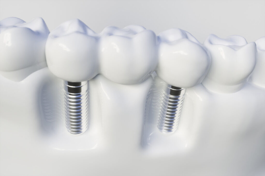 same-day dental implants what happens from consultation to final smile