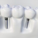 same-day dental implants what happens from consultation to final smile